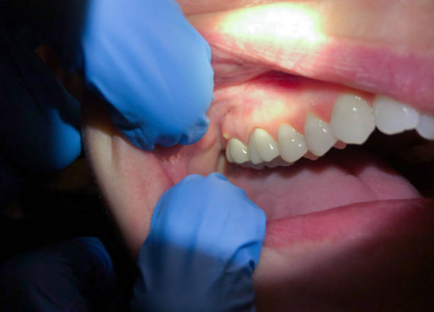 Best Emergency Treatment for Dental Infections or Abscesses in Hawi, HI